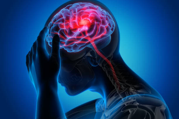 Medical illustration of a brain with stroke symptoms